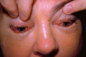 Symtom på trikinos som orsakas av trikiner kan vara svullnad kring ögon, muskelvärk och diarré. Foto: Thom Emory