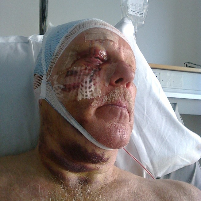 Christer Svensson var nära att dö vid den  otäcka skjutolyckan förra sommaren. Foto: Privat